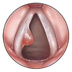Pólipos de las Cuerdas Vocales - Vocal Cord Nodules and Polyps Treatment Program - Dr. Gerardo López Guerra
