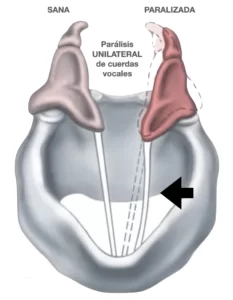 Tratamiento de la Parálisis de cuerdas vocales - Dr. Gerardo López Guerra