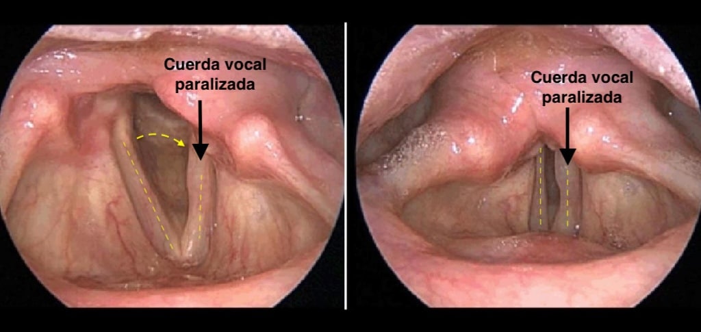 Otorrinolaringólogo especialista en Cuerdas Vocales, Laringología y Trastornos de la Voz.