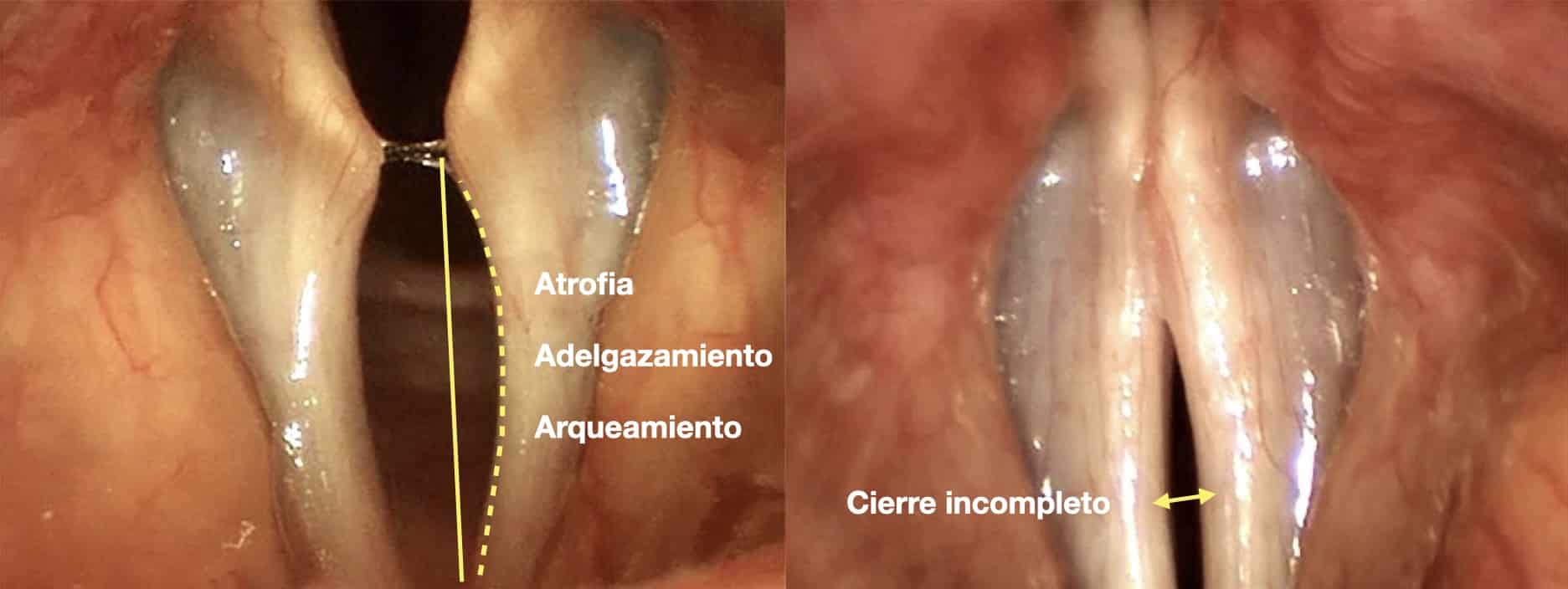 Especialista en Cuerdas Vocales, Laringólogos, Laringología y Trastornos de la Voz