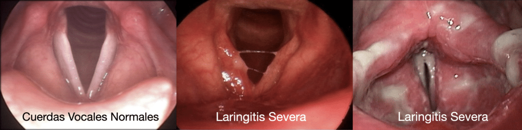 La laringitis es la inflamación de la laringe, el órgano que contiene las cuerdas vocales.