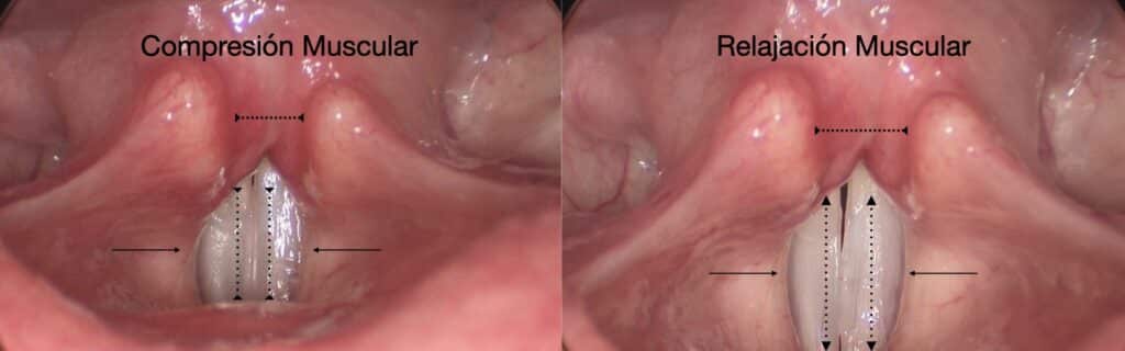 Disfonía por Tensión Muscular: Síntomas, Diagnóstico y Tratamiento
